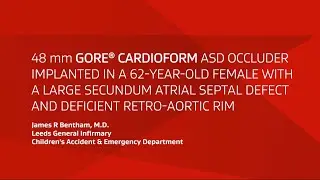 GORE® CARDIOFORM ASD Occluder implant in a large secundum ASD and deficient retro-aortic rim
