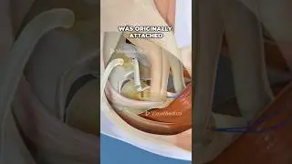 Tommy John Surgery (UCL Reconstruction) (3D Animation)