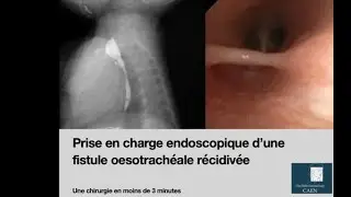 Prise en charge endoscopique d'une fistule oeso-trachéale récidivée