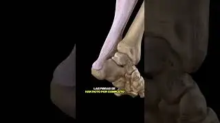 Ruptura del Tendón de aquiles, TENDON ROTO 
