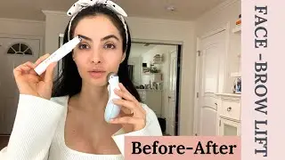 FACE AND BROW LIFT | NON-SURGICAL
