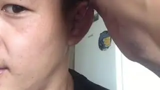 СЛОМАННЫЙ УХА СПОРТСМЕНА.