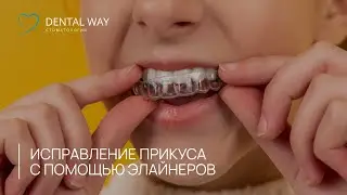 Исправление прикуса с помощью элайнеров в стоматологической клинике Dental Way
