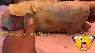 How to removal skin | callus removal skin flakes #31