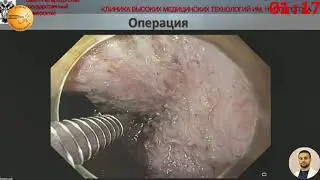 Эндоскопическое удаление дважды рецидивной латерально-распространяющейся опухоли сигмовидной кишки