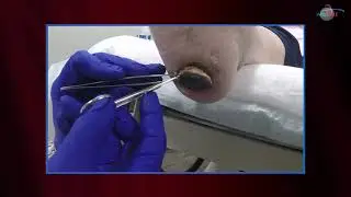WCW: Serial Debridement of Heel Eschar