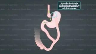 Reversão da Cirurgia de Redução de Estômago