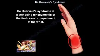 De Quervain's Syndrome - Everything You Need To Know - Dr. Nabil Ebraheim