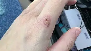 Burn injury healing