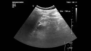 소아당뇨로 인한 신장투석(renal failure)