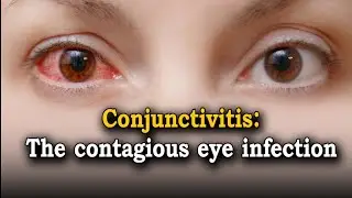 eye infection treatment/conjunctivitis in pakistan