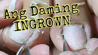 Paano linisan ang paang may sangkatotak na ingrown at dryskin | (Ingrown queen)
