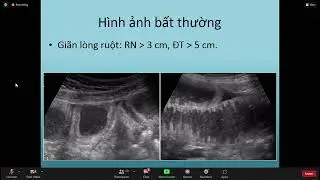 Siêu âm ống tiêu hóa - Siêu âm tổng quát YHN