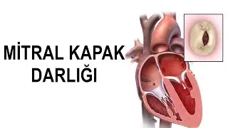 Mitral Kapak Darlığı