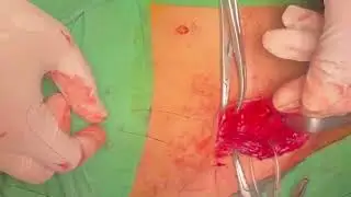 Indirect inguinal hernia repair (bassini) | @dr.bobrambe