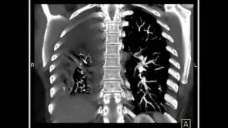 Lung Anatomy: Pulmonary Emboli & Infarcts VRT (4 of 4)