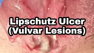 Lipschutz Ulcer|Vulvar Lesions|Causes Riskfactors|Symptoms Diagnosis|Treatment And Prevention