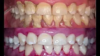 Dental Cleaning being performed on a patient with stain and tartar