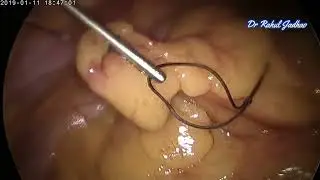 T Lift with suture