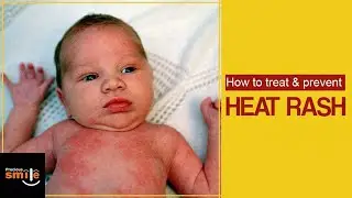 heat rash | heat rash treatment | heat rash on baby