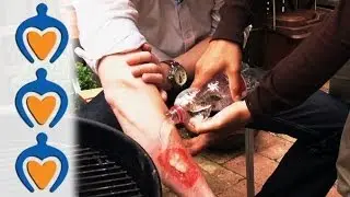 Minor Burn First Aid - Learn how to treat minor burns in less than 1 minute