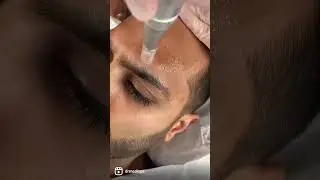 I got Dermapen MicroNeedling Facial 👏🏻 🩸