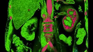 Renal infarction