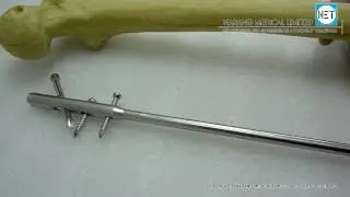 Multi-Fix Femoral Nails, Cannulated.