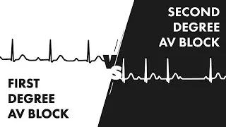 First vs Second Degree Heart Block - EKG Rhythm Interpretation