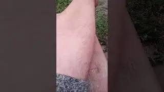Как избавиться от грибка на ногах?