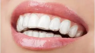 Clear Braces Cardiff - Birchgrove Dental Practice