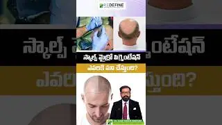Scalp Micropigmentation Telugu || #shorts #ytshorts #scalpmicropigmentation #pigmentation