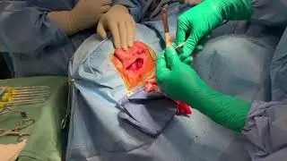 Artz Cochlear Implant Surgery