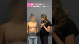1 месяц после Т-образной подтяжки на имплантах и нижней классической блефаропластики