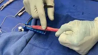 What does a hamstring tendon anterior cruciate ligament graft look like?
