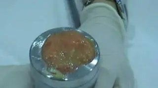 liposuzione