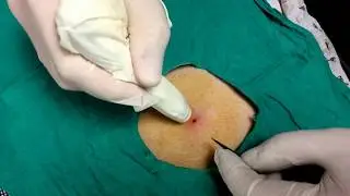 Magnas ile cilt altı magnetik özellikli yabancı cisim çıkarma