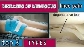 Meniscal disease | 3 types |