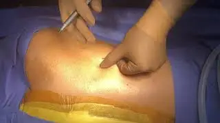 robotic Esophagectomy port placement