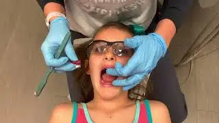 How to Deliver an Orthodontic Expander