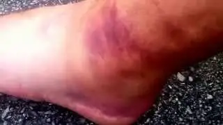 BRUISED ANKLE FAIL