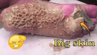 How to removal skin | callus removal skin flakes #44