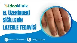 Eldeki Siğillerin Lazerle Tedavisi Nasıl Yapılır? - IDEA Klinik