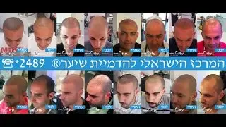 הדמיית שיער לגברים אמן הדמיית זקיקים לגבר - נקודות בקרקפת