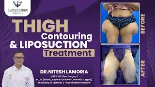 “Transforming Confidence: 360° Body Contouring at Purple Heron Hospital” jaipur🏥
