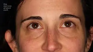 The Eye Love Project
