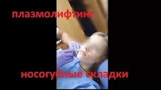 Плазмолифтинг для носогубок