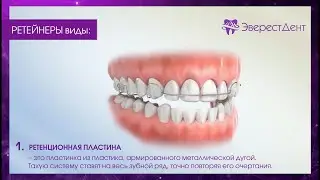 Ретейнеры.
