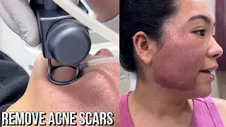 First CO2 laser! Consultation + Laser Session