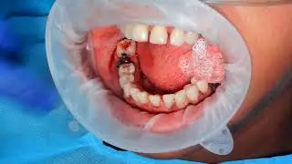 36,46 - intraoral syncrystallisation by using 1.2 mm titanium wire